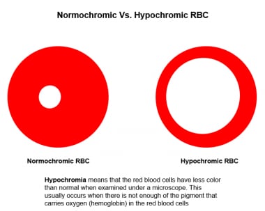 Normochromic vs hypochromic red blood cell (RBC).