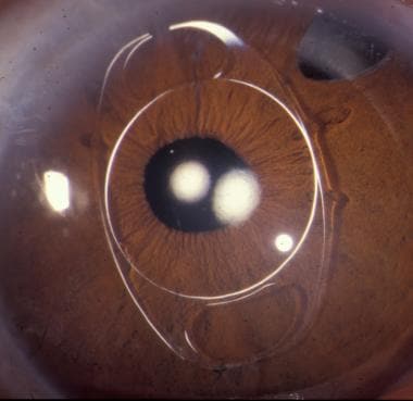 Megalocornea patient with Artisan lens. 