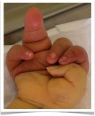 Clinical picture of right hand of 5-day-old boy wi