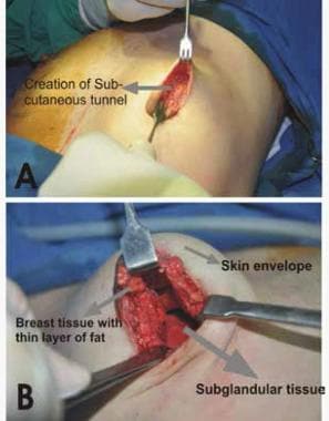 These images of the periareolar approach to breast