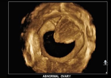 3D transvaginal sonography of ovarian cancer. Sing