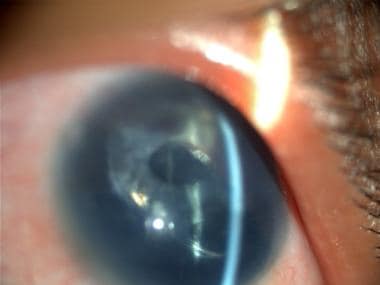 In-the-bag intraocular lens. The lens has been dis