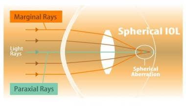 Spherical aberration: a schematic diagram for the 