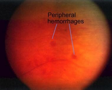 Fundus of a patient with nonischemic central retin