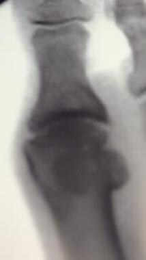Joint-space narrowing, marginal osteophytes, and i