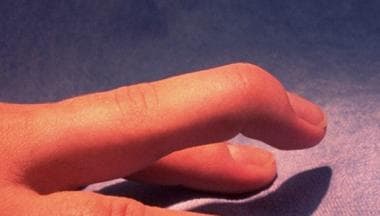 Typical mallet finger deformity. 