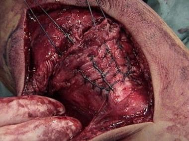 Patellar tendon rupture. Two Krackow stitches with
