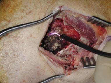 Giant cell tumor. Intraoperative photograph of dis
