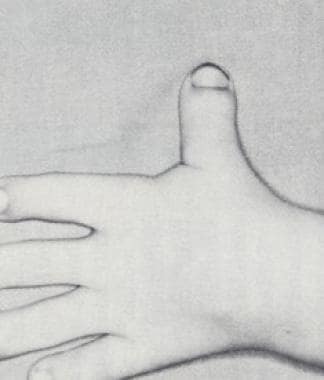 Characteristic abducted position of the thumb in a