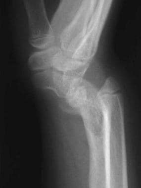 Preoperative lateral wrist radiograph of patient A