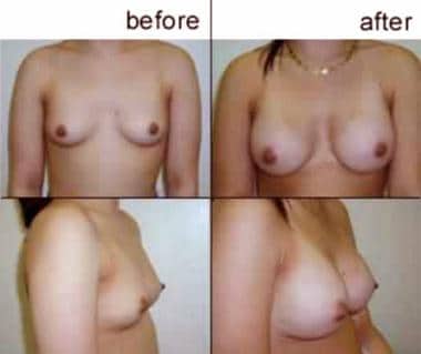 Breast augmentation, subglandular. A cup to Large 