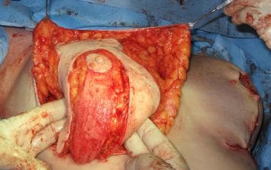 The hand of the surgeon holds the entire gland bef