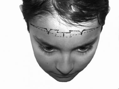 Mid forehead brow lift. Elevation of the cutaneous