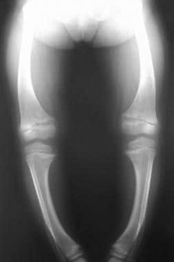 Radiograph in a 4-year-old girl with rickets depic