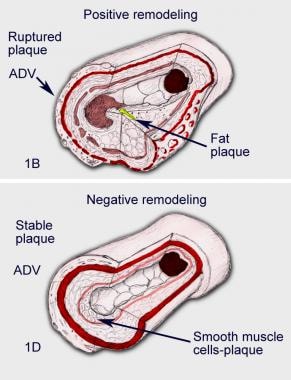 A Definition of Advanced Types of Atherosclerotic Lesions and a  Histological Classification of Atherosclerosis