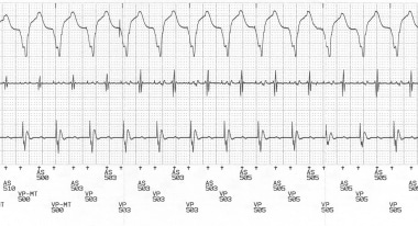Pacemaker-Mediated Tachycardia. Telemetered ECG tr