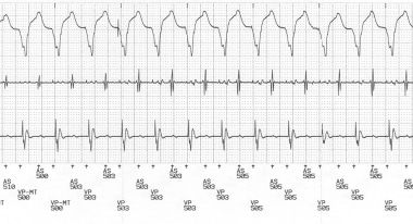 Telemetered ECG tracing with surface lead II (top)