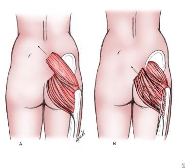 How to prevent pressure ulcers on the buttocks? - O Neill Healthcare