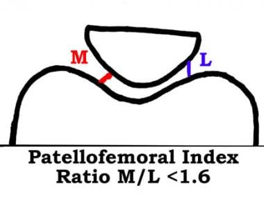 Patellofemoral arthritis. The patellofemoral index
