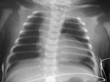 An uplifted apex and absence of pulmonary artery s