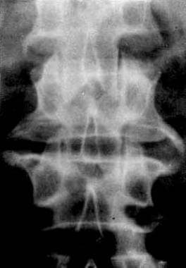 Anteroposterior view of lumbar spine. Vertical ove