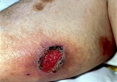 blastomycosis skin lesions