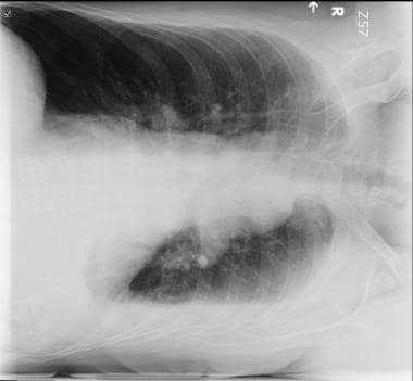 Best Practices: Tube Thoracostomy Insertion