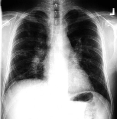 A chest radiograph of stage III sarcoidosis. This 