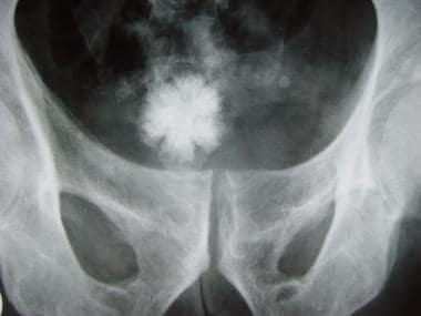 Large stellate urinary bladder stone. Image courte