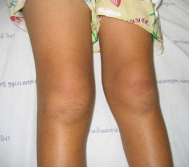 Swelling of right knee with effusion caused by art