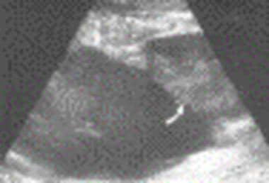 Sonogram showing large anechoic fluid collection i