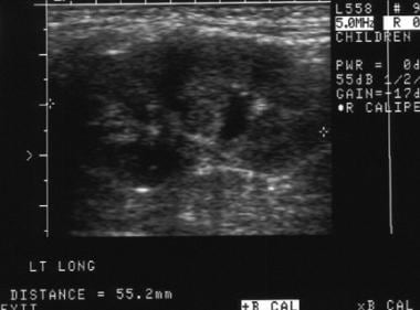 Ultrasound image of the same patient (in Picture 2