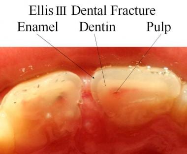 Cross section of an Ellis III dental fracture. 