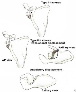 Classification of glenoid neck fractures. Type I i