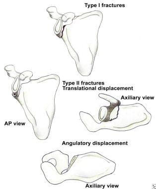 Classification of glenoid neck fractures. Type I i