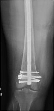 An intra-articular distal femur fracture treated w