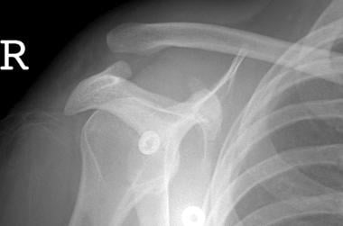 Anteroposterior (AP) radiograph of right shoulder 