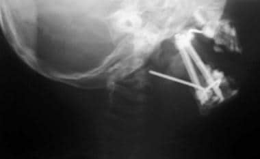 Lateral radiograph of same patient as in Media fil