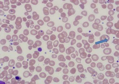 basophilic stippling thalassemia