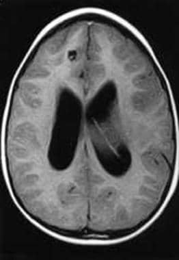Case 1: Axial image MRI of a 6-year-old boy from P