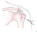 Bicipital Tendon Injection