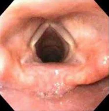 Glottic view via video-assisted laryngoscopy. Used