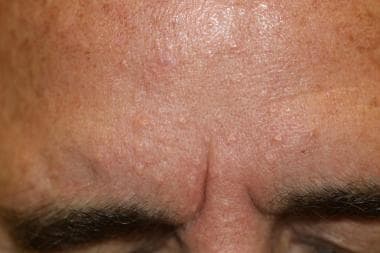 Typical distribution of sebaceous hyperplasia on t