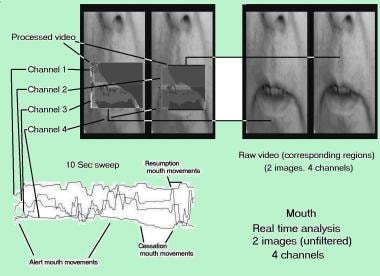 Multichannel correlation of mouth region configura