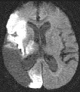 The diffusion-weighted MRI reveals a region of hyp