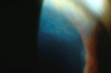 Interstitial keratitis in a patient with ocular sy