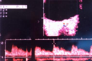 von Hippel-Lindau disease. Spectral display of the