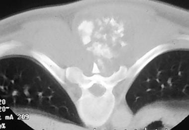 Spinal tumors. Axial CT scan at level of chondrosa