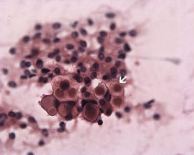 Meningiomas Pathology. Enlarged secretory vacuoles