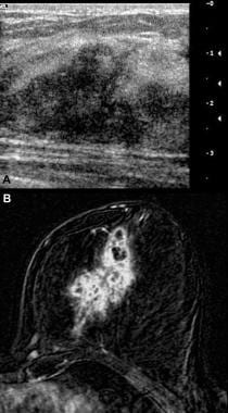 Findings of the right nipple; ultrasound and MR images of the breast. a